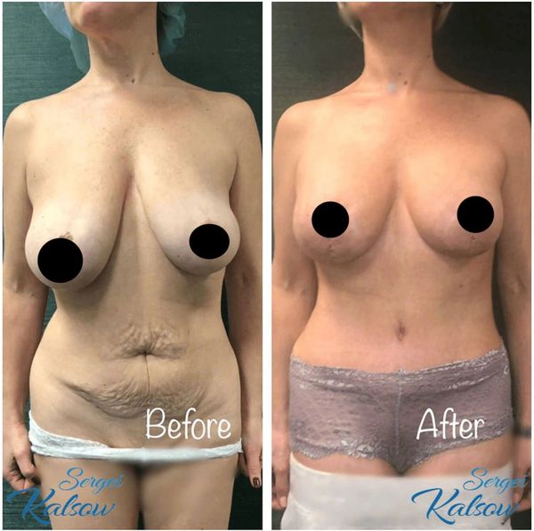 Mommy makeover - breast lift with implants, and full tummy tuck.