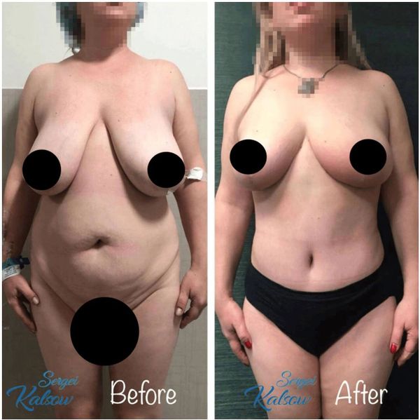 Mommy makeover - breast lift, full tummy tuck and liposuction of flanks.