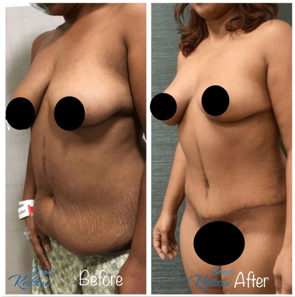 Mommy makeover - breast lift, full tummy tuck and liposuction of flanks.