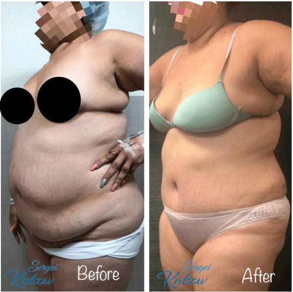 High BMI tummy tuck.