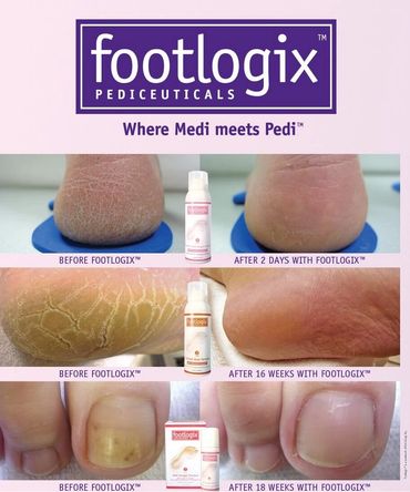 Peeling skin and cracked heels