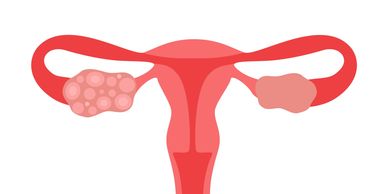 cystes of blaasjes op eierstok PCOS
menstruatie weinig of onregelmatig
hormonen zwanger vruchtbaar