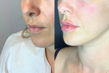 Before and after lip enhancement showing fuller lips and smoother skin.