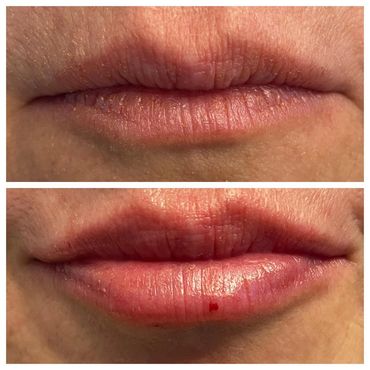 Close-up of lips before and after a cosmetic procedure.