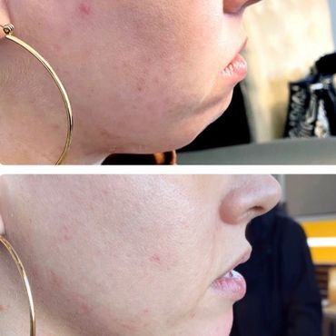 Side-by-side comparison of a person's chin and jawline before and after skin treatment.