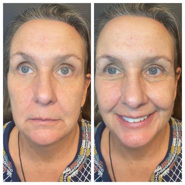 Before and after images showing a woman with a neutral expression and then smiling.