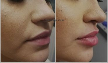Close-up before and after images showing smoother skin and enhanced lips.