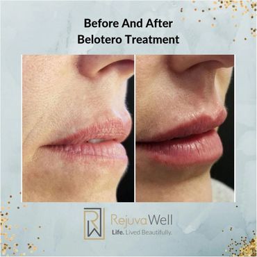Before and after photos of lips treated with Belotero for smoother, fuller appearance.