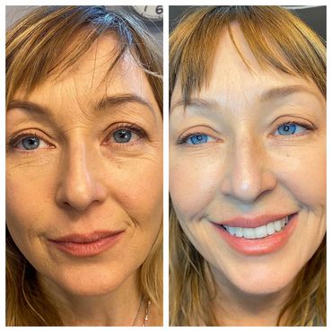 Side-by-side close-up of a woman's face showing before and after a cosmetic dental transformation.