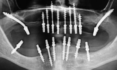 zygomatic implants in chandigarh