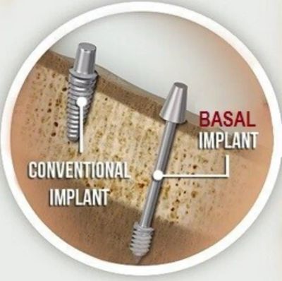 Basel implants in chandigarh