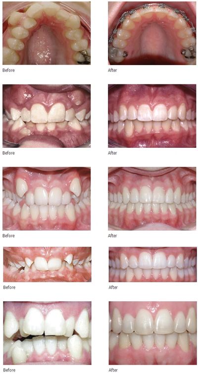 best full mouth implants in chandigarh
