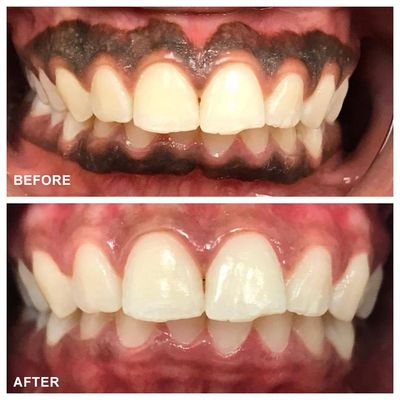 Gum Depigmentation in Chandigarh