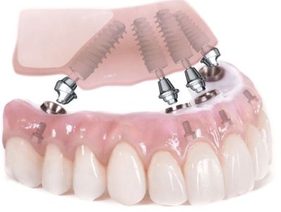 Modelo All on 4 Nobel biocare