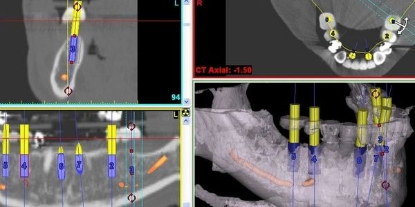 Softwere de planeación cirugía de implantes dentales