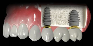 puente sobre implantes dentales