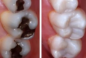 resinas mejor clínica dental monterrey best dental clinic white fillings mexico 
