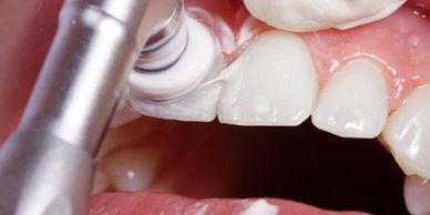 Limpieza dental profesional