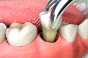 extracciones dentales