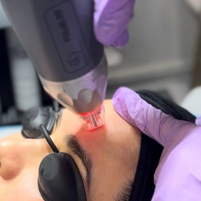 Professional facial laser treatment on forehead under eye protection.