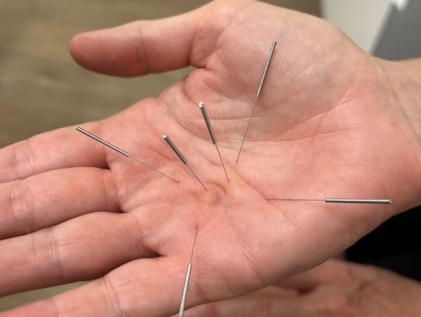 Traditional chinese herbal medicine and acupuncture used in this case for Trigger Finger