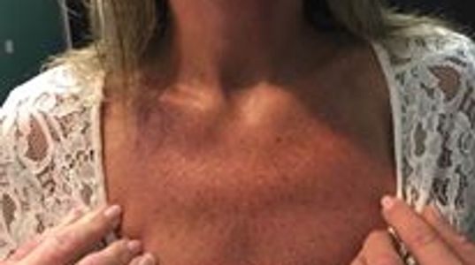 Severe third-degree burn injury healing timeline across one week.