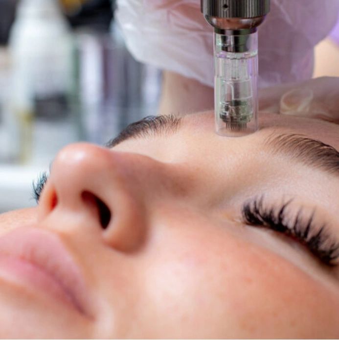 Microneedling Treatment by Permanently You By Kelly in Pennsylvania.