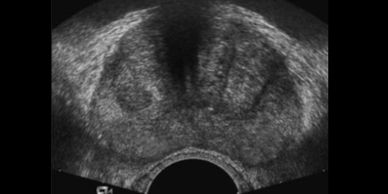 El ultrasonido de próstata transrectal se utiliza para buscar nódulos sospechosos y realizar biopsia