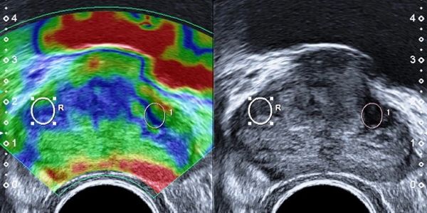 Elastografía de próstata y ultrasonido en tiempo real de próstata, evaluando nódulos