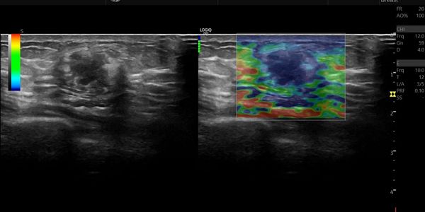 Elastrografía de mama y ultrasonido de una masa en mama, para evaluar si hay signos de cáncer.