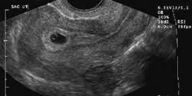 El ultrasonido es una prueba de imágenes en las que se utilizan ondas sonoras para examinar órganos.