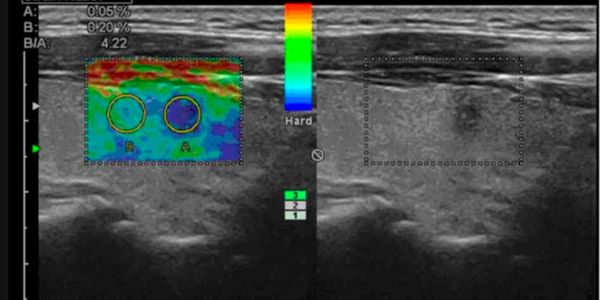 Ultrasonido tiroideo y Elastografía de glándula tiroides para evaluar nódulos.