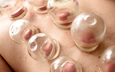 Patient has 9 glass cups placed along his back. Cupping marks are pink/red in color