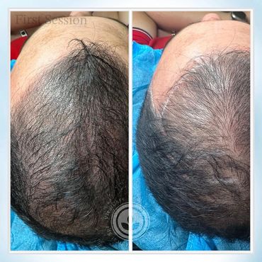 Hair loss treatments in tampa bay - Guarantee results - best Scalp Micropigmentation  in tampa bay