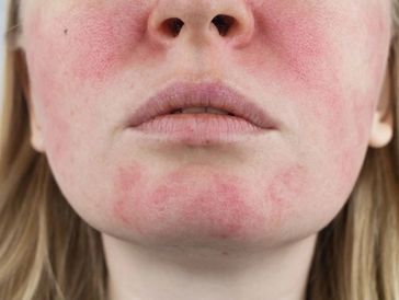 a woman with red spots all on her face