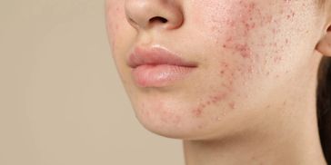 A young girl with acne on her face