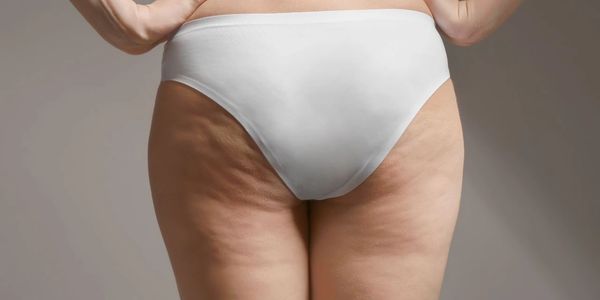 a woman's butt with cellulite on her legs