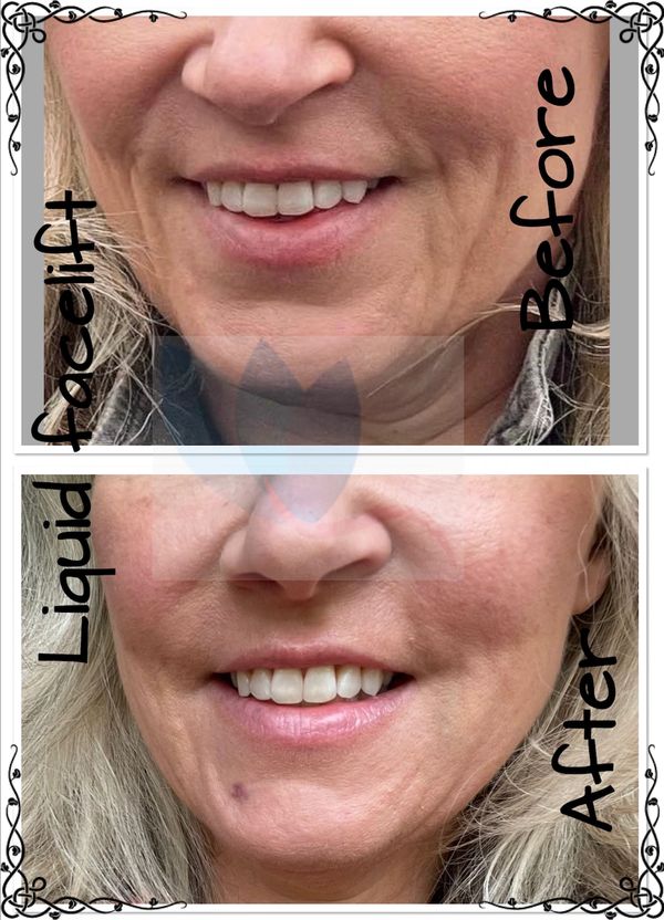 Before and after photo of woman 8 point lift technique