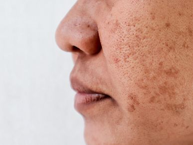 side profile of a face showing skin pigmentation spots.