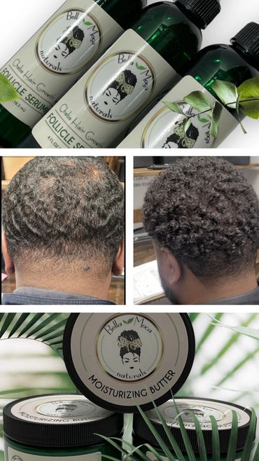 Client  sufferd from bald patches and used our Chebe hair growth follicle serum and hair butter.