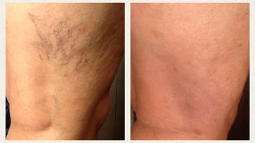Sclerotherapy and laser vein therapy