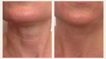 Injections with Restylane Silk