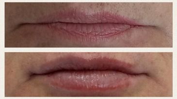 Lip augmentation with Versa lips, Restylane Kyss, Juvederm
