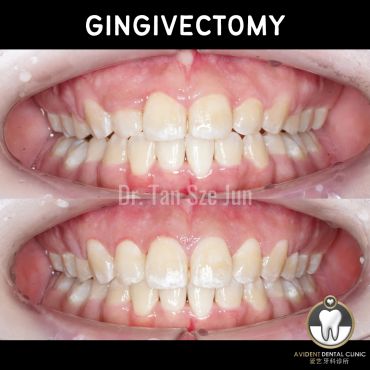 Before and after gingivectomy dental treatment