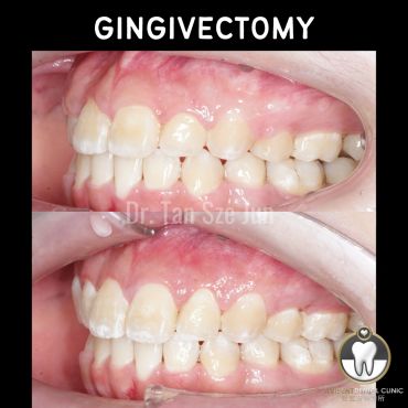 Before and after gingivectomy dental procedure images.