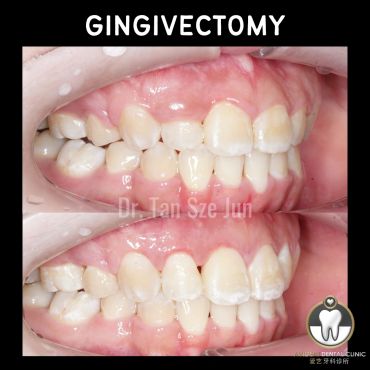 Before and after gingivectomy showing improved gum line.