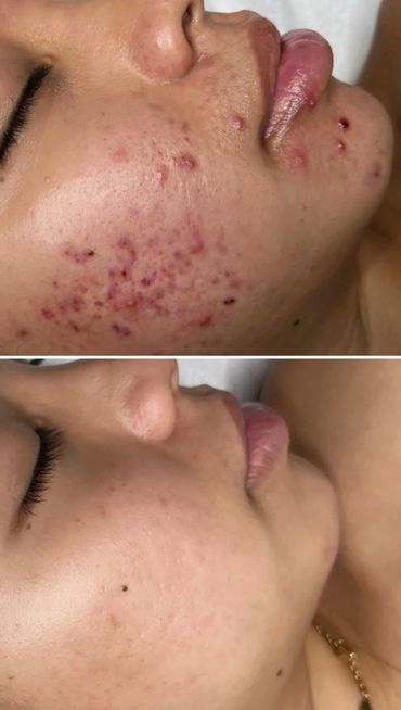 3 ACNE FACIALS