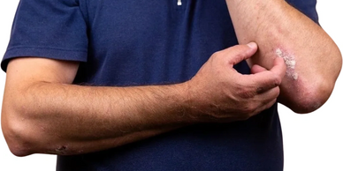 A man in a blue shirt with eczema on his elbow.