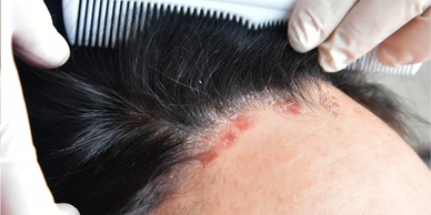 A person's forehead with psoriasis showing at the hairline.