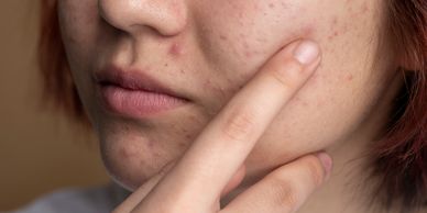 A teen or young woman with acne.